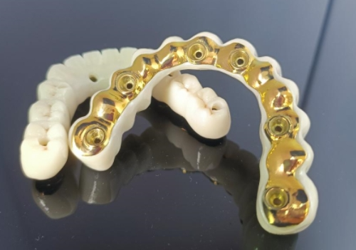 Tytanowa belka implantu CAD/CAM + most cyrkonowy