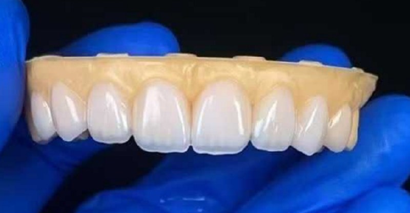 Forniry dentystyczne w celu naprawy problemu nadmiernych szczelin zębów