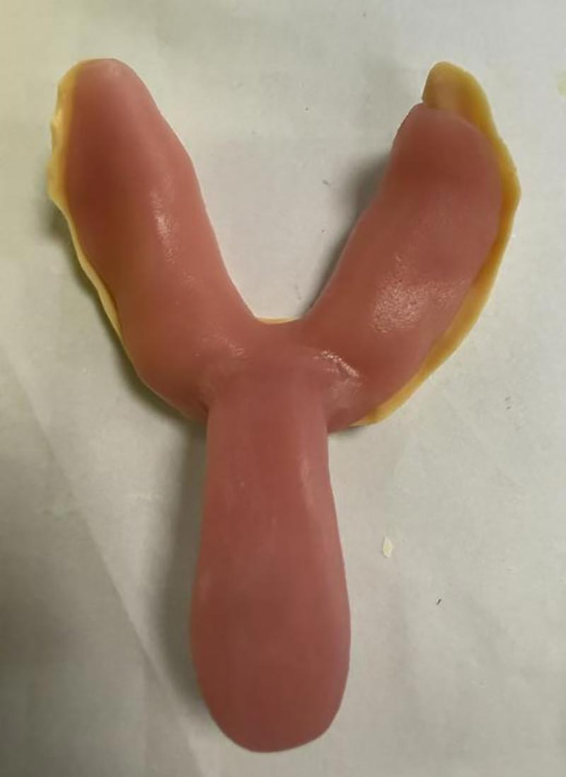 Rzeczy, których nie wiedziałeś o niestandardowych nakładkach dentystycznych