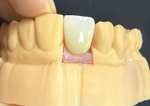 Luki między zębami można naprawić — proste zęby są najbardziej atrakcyjne!