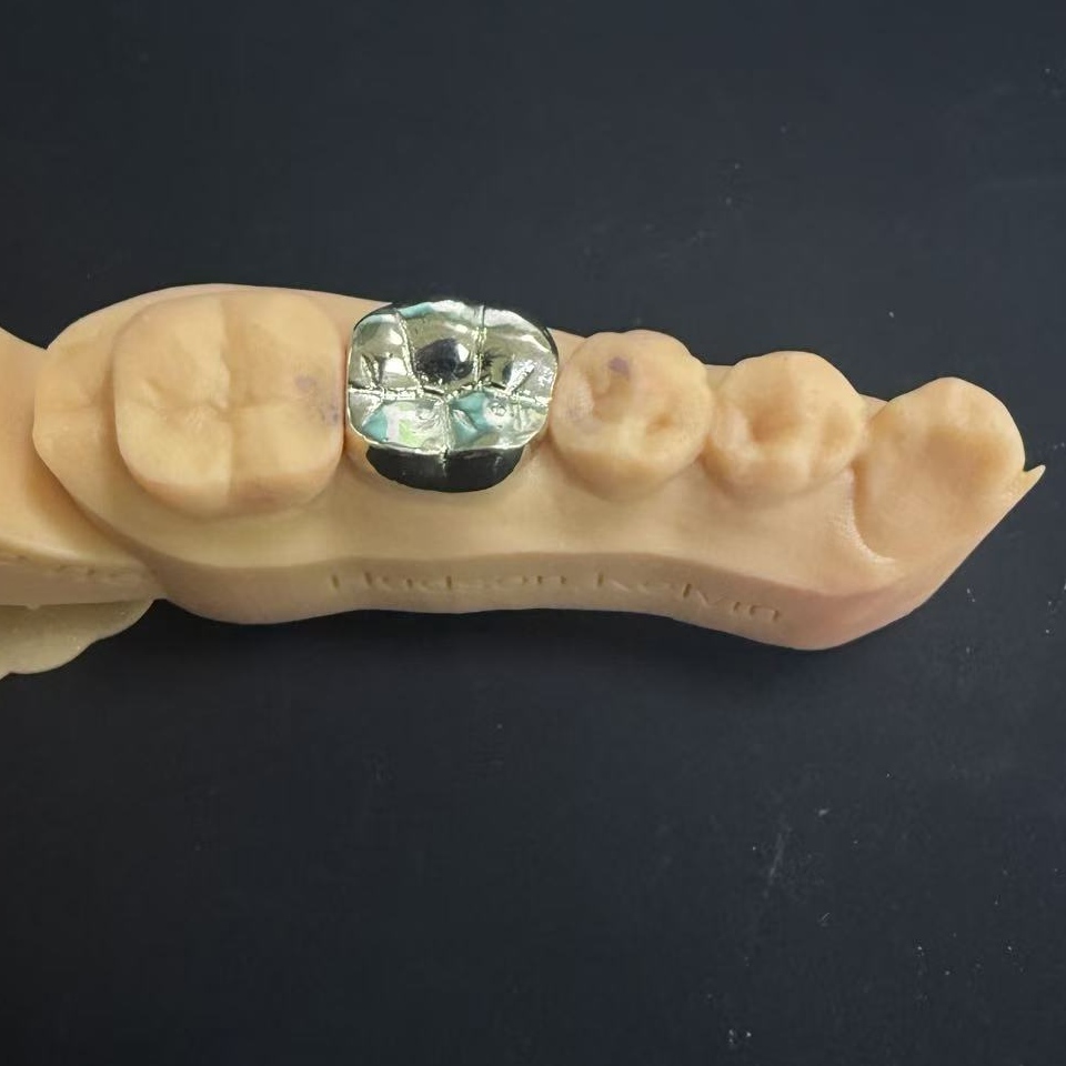 Złote korony: wybór metali szlachetnych w celu odbudowy zębów na całe życie