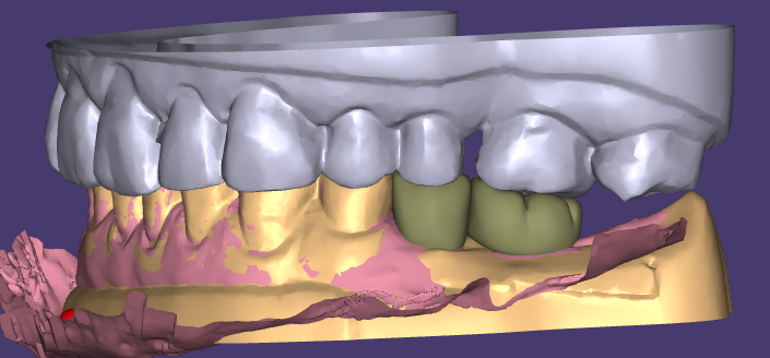 Estetyczne woskowanie i uzupełnienia tymczasowe WM Dental Lab zdobywają jednomyślne uznanie klientów