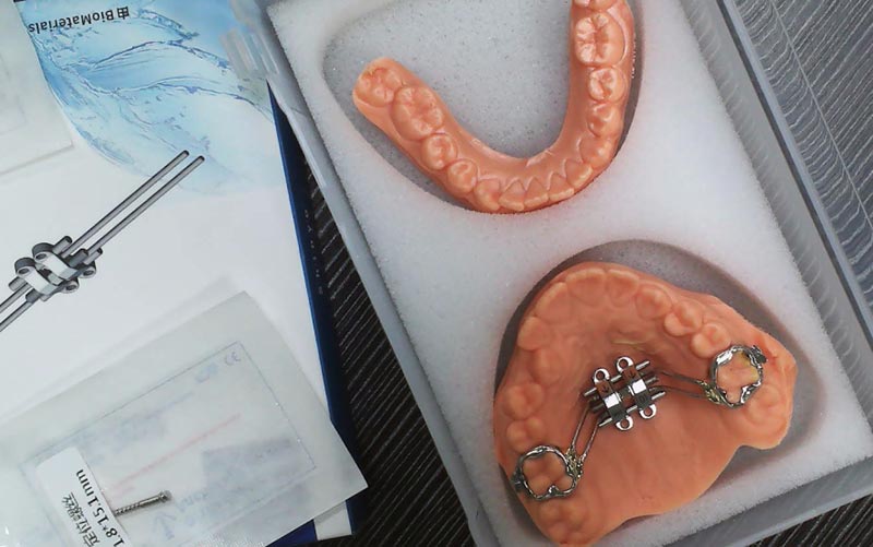 Zrozum ekspansję szkieletu MSE dzięki WM Dental Lab