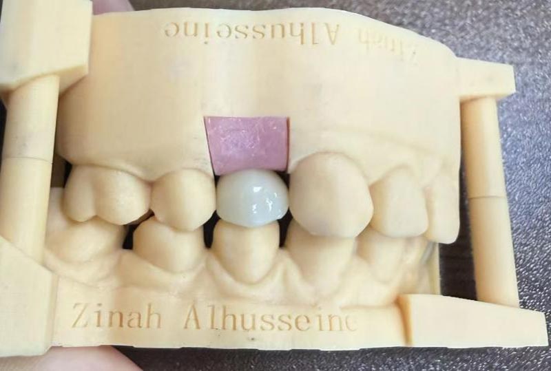 Bezpieczeństwo i środki ostrożności dotyczące implantów dentystycznych