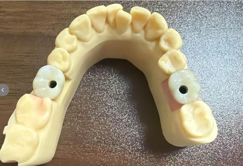 Dlaczego implantacja zęba przedniego jest trudniejsza niż implantacja zęba tylnego?